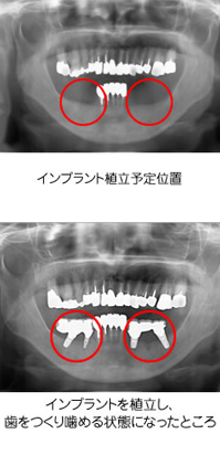 人工の歯（人工歯根）をつける治療