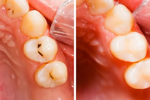 進行したむし歯（C1、2）/コンポジットレジン修復、インレー・アンレー修復