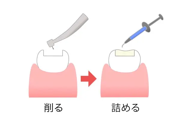 進行したむし歯（C3）/歯の根の治療