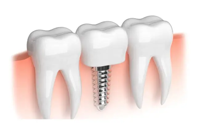 進行したむし歯（C4）/抜歯もしくは歯の根の治療